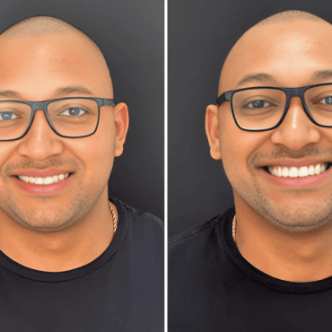 Facetas De Porcelana em Tapete Verde